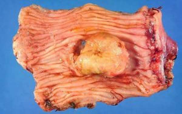 Рак при ревматоидном артрите